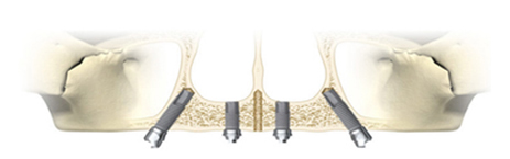 岳歯科クリニックのAll-on-4/All-on-6インプラント治療