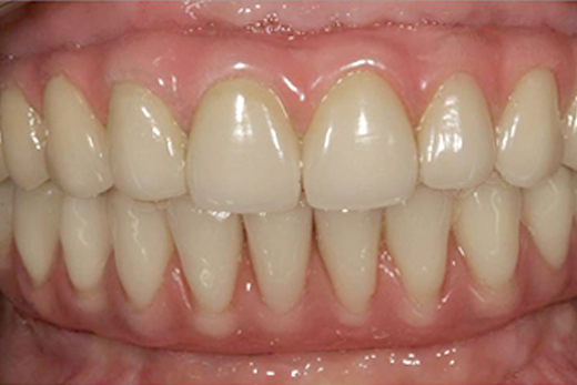 All-on-4インプラント治療後の歯の写真