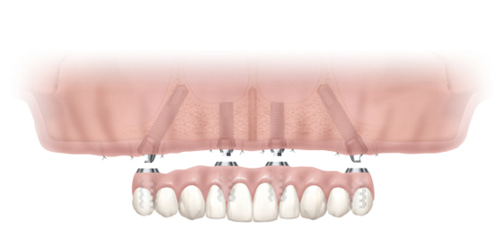 All-on-6は総入れ歯の方以外にも残存歯が少ない方にとっても効率的かつ効果的な治療方法となりえます