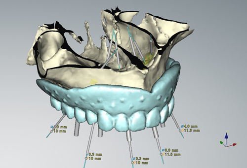 サージカルテンプレートを使用したインプラント手術イメージ