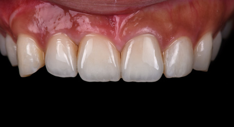 インプラント治療後の前歯の写真