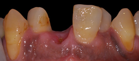 前歯の審美インプラント治療前の写真