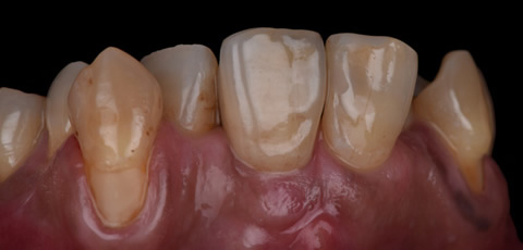 前歯の審美インプラント治療後の写真