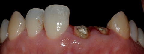 前歯の審美インプラント治療前の写真