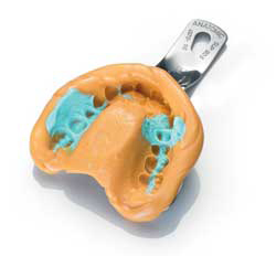 抜歯即日（抜歯即時）インプラント治療1日の流れ3 咬合採得